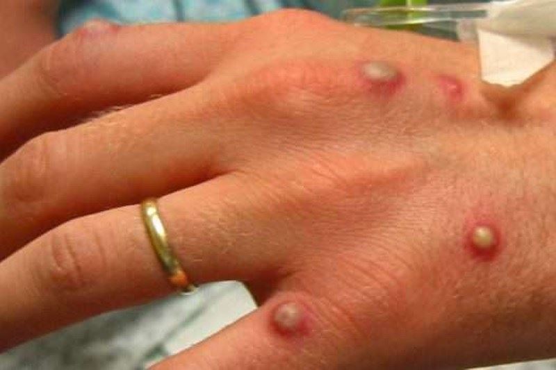 الصحة العالمية تعلن ارتفاعاً كبيراً بإصابات جدري القردة