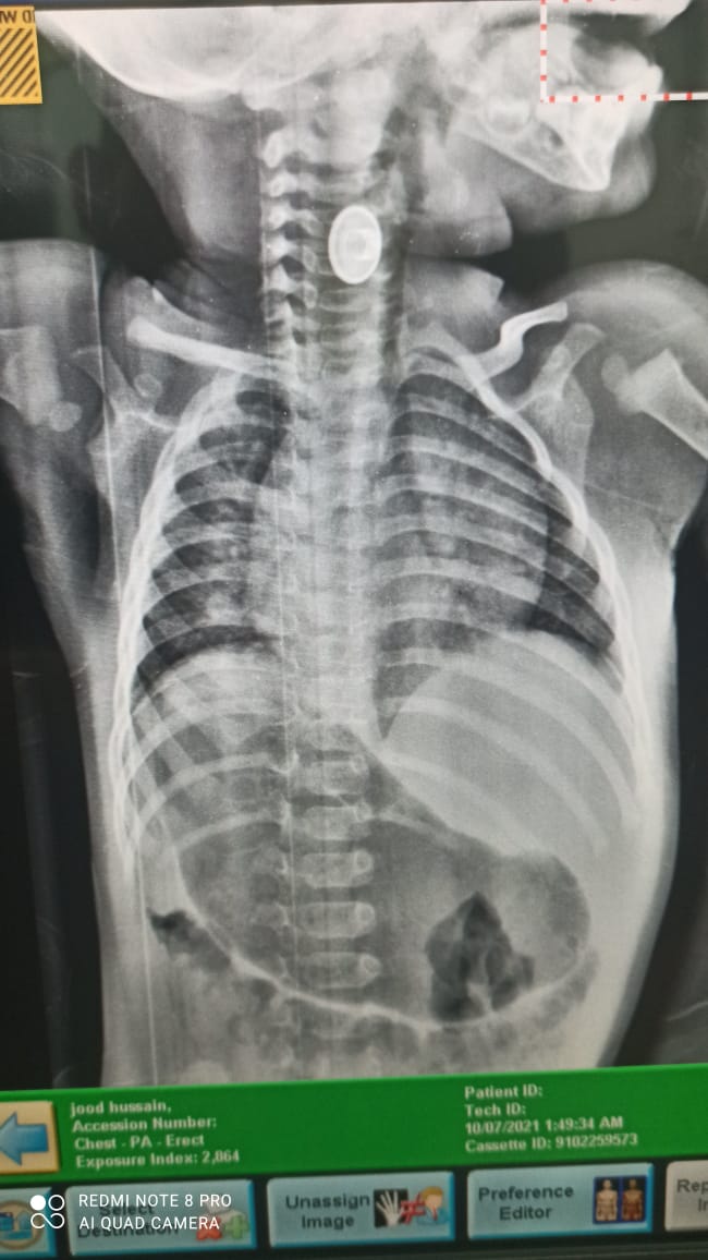 بالصور.. إستخراج جسم معدني من مريء طفل في قضاء عين التمر بكربلاء