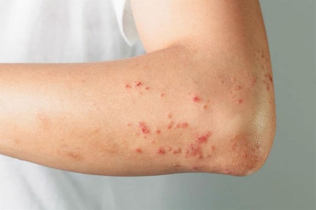 في مدارس محافظة عراقية.. تسجيل إصابات مؤكدة بمرض "جدري الماء"