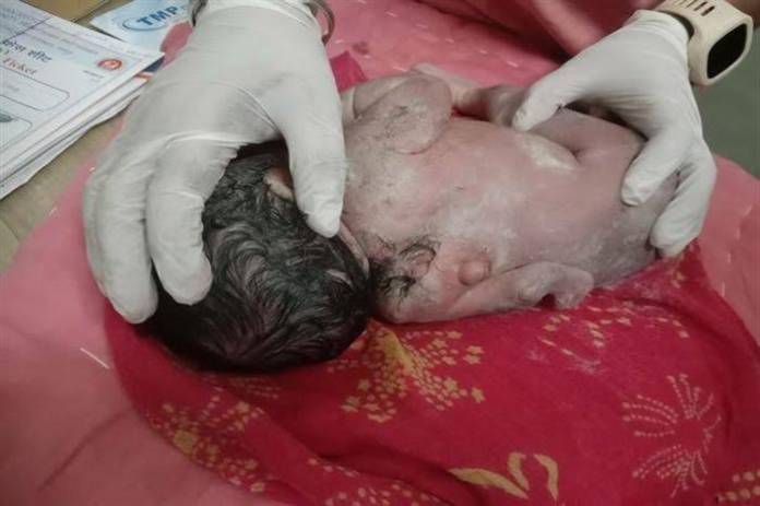 الهند:ولادة طفل بثلاث أيادي